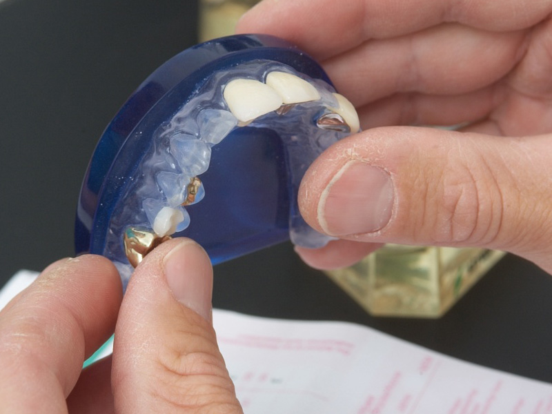 Zahnersatz - Brücke